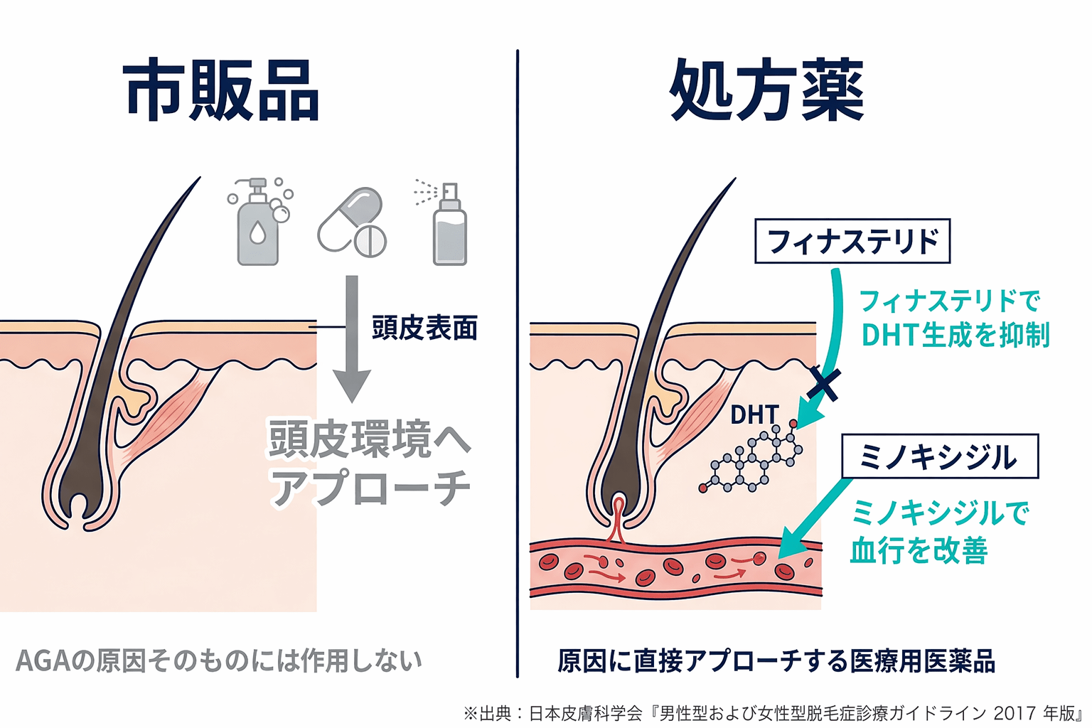 市販品と医師処方のAGA治療薬の違い
