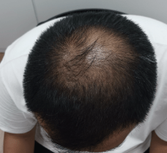 症例A ビフォー