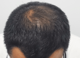 症例A アフター